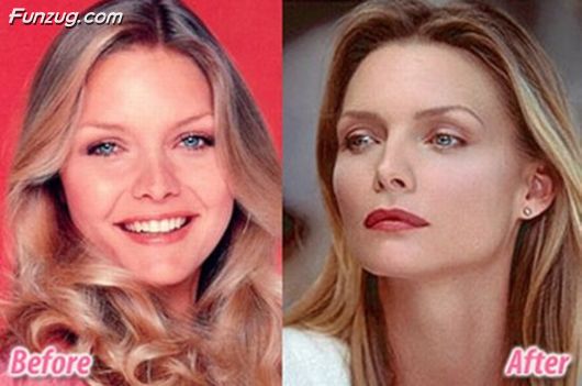 Stars Before And After Plastic Surgery