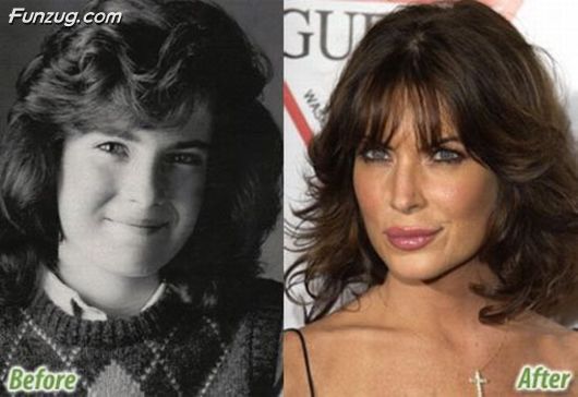 Stars Before And After Plastic Surgery