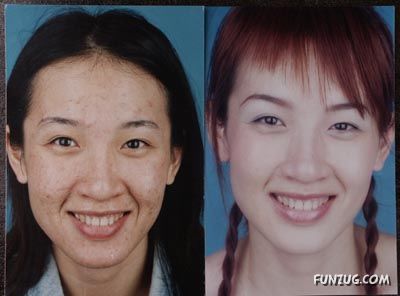 Good Tips to Remove Acne Scars